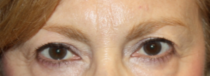 Blepharoplasty Before & After Patient #24966