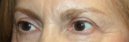 Blepharoplasty Before & After Patient #24966