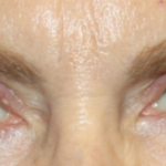 Blepharoplasty Before & After Patient #24966