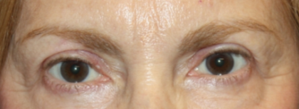 Blepharoplasty Before & After Patient #24966