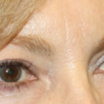 Blepharoplasty Before & After Patient #24966