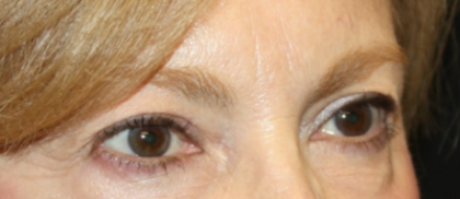 Blepharoplasty Before & After Patient #24966