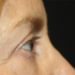 Blepharoplasty Before & After Patient #24966