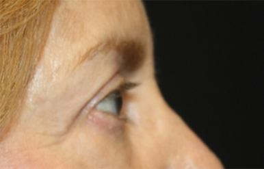 Blepharoplasty Before & After Patient #24966