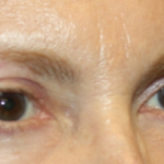 Blepharoplasty Before & After Patient #24966