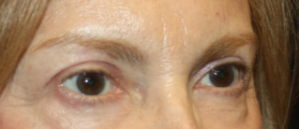 Blepharoplasty Before & After Patient #24966