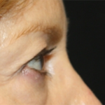 Blepharoplasty Before & After Patient #24966