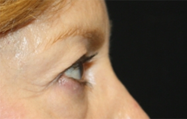 Blepharoplasty Before & After Patient #24966