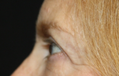 Blepharoplasty Before & After Patient #24966