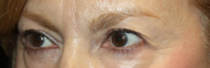 Blepharoplasty Before & After Patient #24966