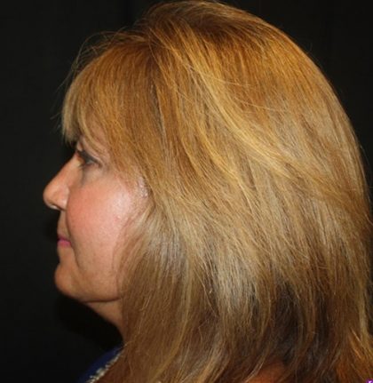 Facelift Before & After Patient #21137