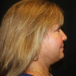 Facelift Before & After Patient #21137