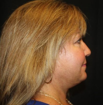 Facelift Before & After Patient #21137