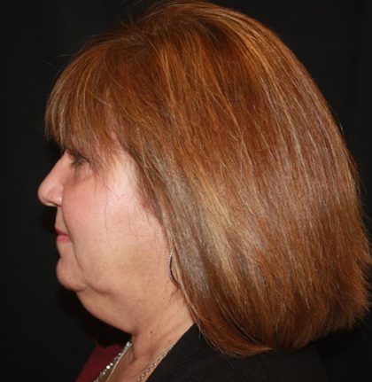 Facelift Before & After Patient #21137