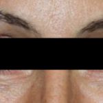 Botox and Dysport Before & After Patient #24747