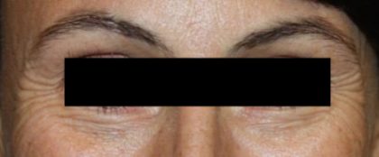 Botox and Dysport Before & After Patient #24747