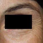 Botox and Dysport Before & After Patient #24747