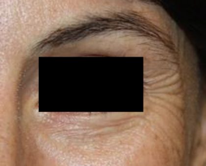 Botox and Dysport Before & After Patient #24747