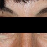 Botox and Dysport Before & After Patient #24747