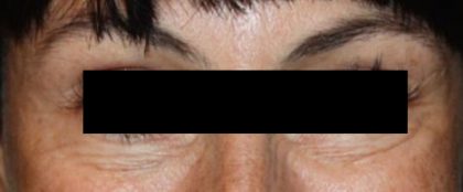 Botox and Dysport Before & After Patient #24747