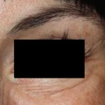 Botox and Dysport Before & After Patient #24747