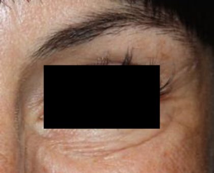 Botox and Dysport Before & After Patient #24747