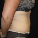 Tummy Tuck Before & After Patient #22939