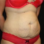 Tummy Tuck Before & After Patient #22939