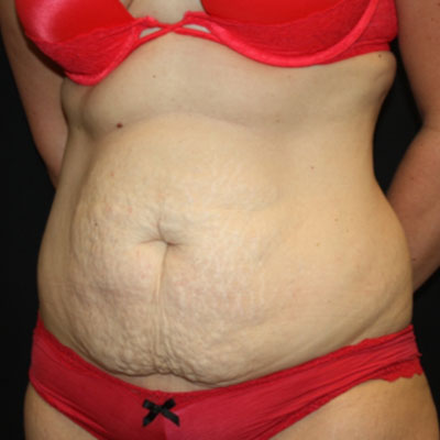 Tummy Tuck Before & After Patient #22939