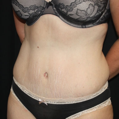 Tummy Tuck Before & After Patient #22939