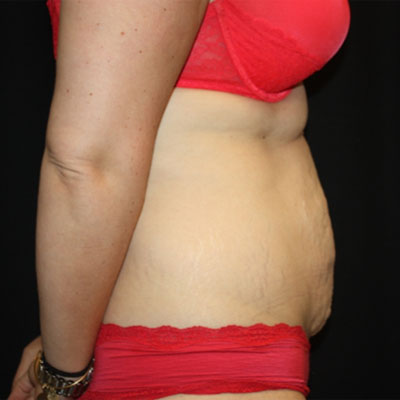 Tummy Tuck Before & After Patient #22939