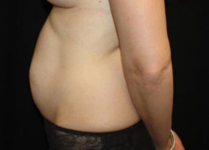 Tummy Tuck Before & After Patient #22963