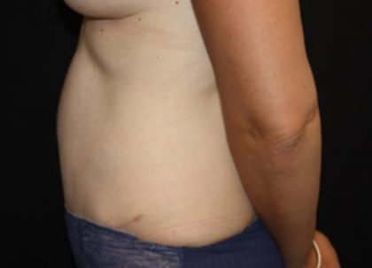 Tummy Tuck Before & After Patient #22963