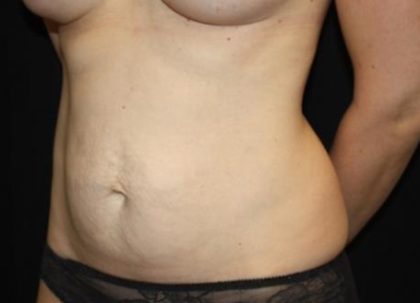 Tummy Tuck Before & After Patient #22963