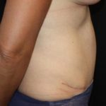 Tummy Tuck Before & After Patient #22963