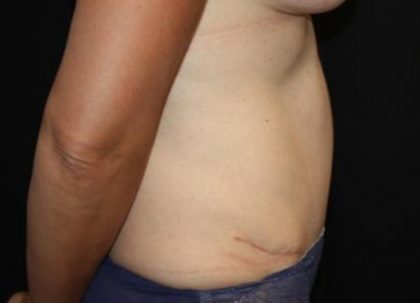 Tummy Tuck Before & After Patient #22963