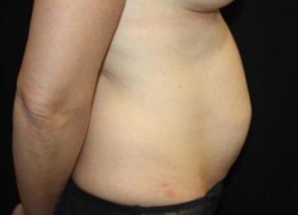 Tummy Tuck Before & After Patient #22963