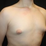 Gynecomastia Before & After Patient #21261