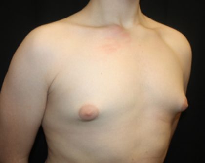 Gynecomastia Before & After Patient #21261