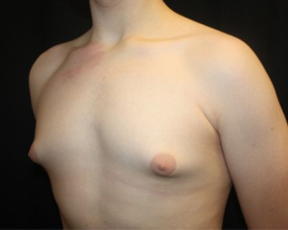 Gynecomastia Before & After Patient #21261