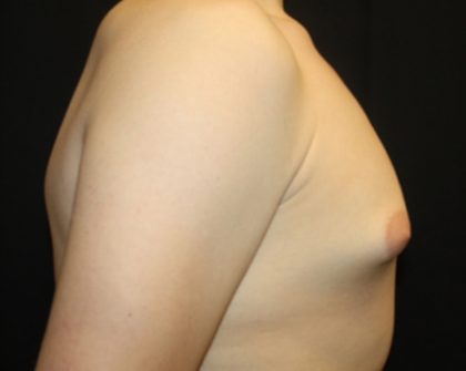 Gynecomastia Before & After Patient #21261