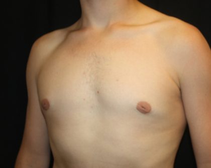 Gynecomastia Before & After Patient #21261