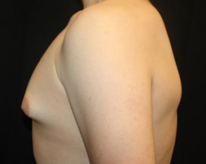 Gynecomastia Before & After Patient #21261