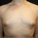 Gynecomastia Before & After Patient #21261