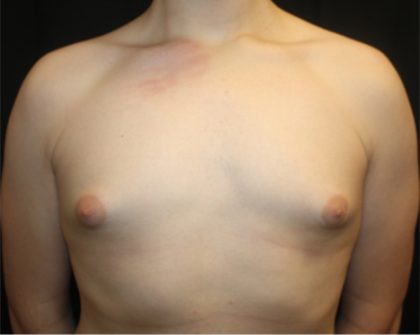 Gynecomastia Before & After Patient #21261