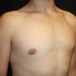 Gynecomastia Before & After Patient #21261