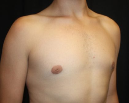 Gynecomastia Before & After Patient #21261