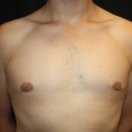 Gynecomastia Before & After Patient #21261