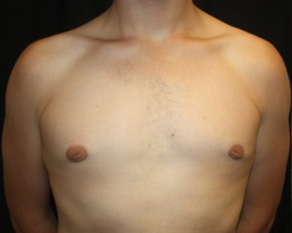 Gynecomastia Before & After Patient #21261