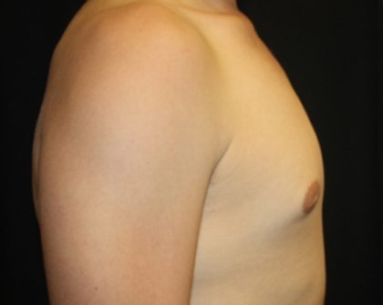 Gynecomastia Before & After Patient #21261